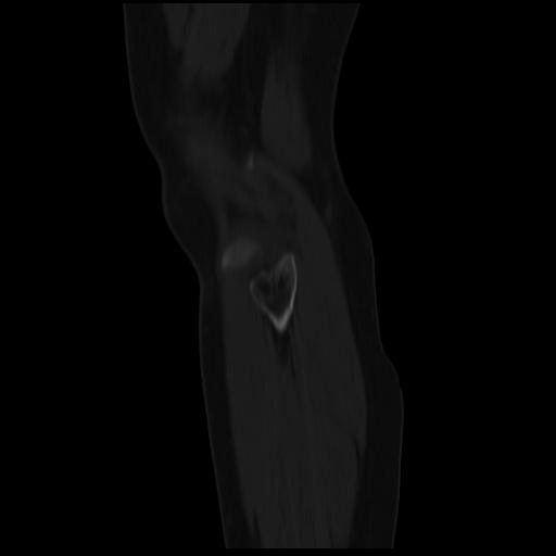 File:ACL avulsion fracture (Radiopaedia 33833-34994 Sagittal bone window 5).jpg