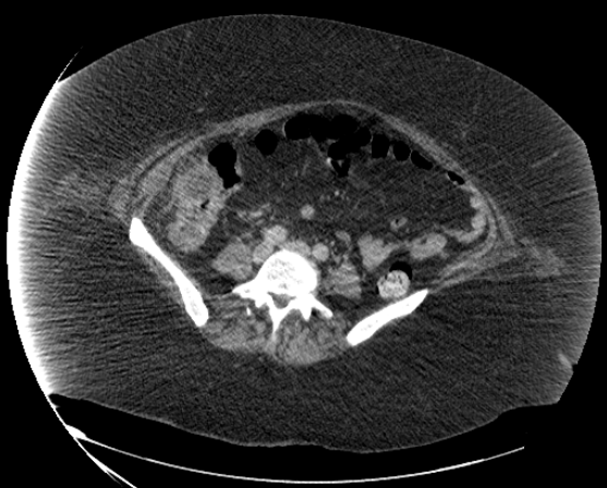 File:Abdominal abscess - pre and post percutaneous drainage (Radiopaedia 60209-67816 Axial 52).png