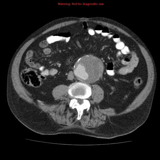 Abdominal aortic aneurysm (Radiopaedia 10122-10660 Axial C+ portal venous phase 46).jpg
