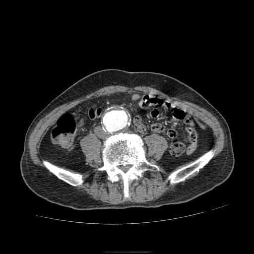 Abdominal aortic aneurysm (Radiopaedia 13341-13340 Axial C+ arterial phase 143).jpg