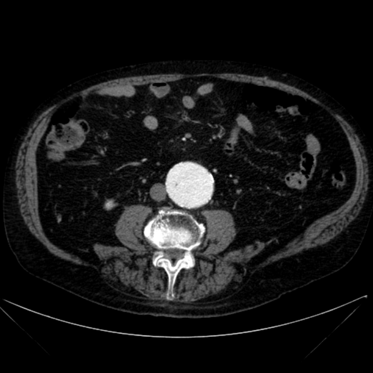 Abdominal aortic aneurysm (Radiopaedia 25855-26001 Axial C+ arterial phase 76).jpg