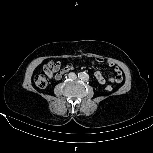 Abdominal aortic aneurysm (Radiopaedia 85063-100606 Axial C+ delayed 73).jpg