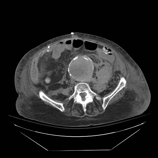 Abdominal aortic aneurysm - impending rupture (Radiopaedia 19233-19247 Axial non-contrast 109).jpg