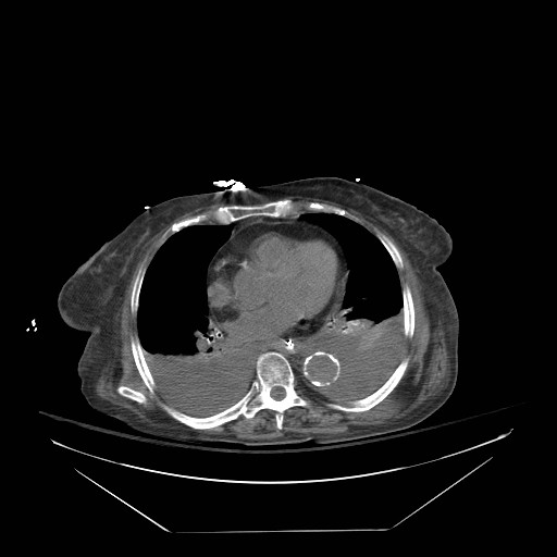 Abdominal aortic aneurysm - impending rupture (Radiopaedia 19233-19247 Axial non-contrast 12).jpg