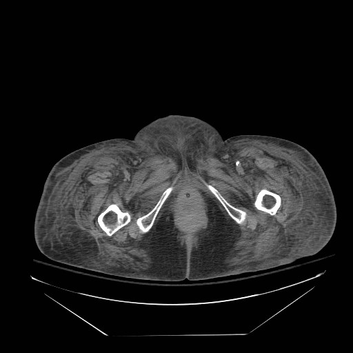 Abdominal aortic aneurysm - impending rupture (Radiopaedia 19233-19247 Axial non-contrast 177).jpg