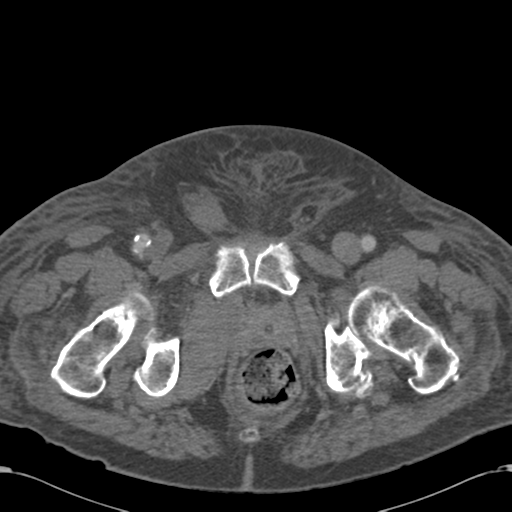 Abdominal hematoma (Radiopaedia 33614-34715 Axial C+ portal venous phase 133).png