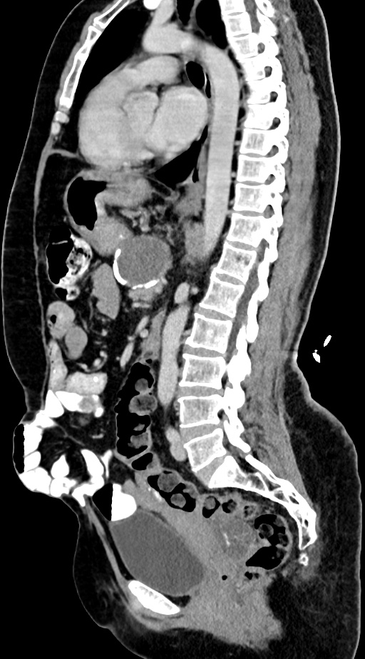 Abdominal hydatid disease (Radiopaedia 68223-77737 Sagittal C+ portal venous phase 33).jpg