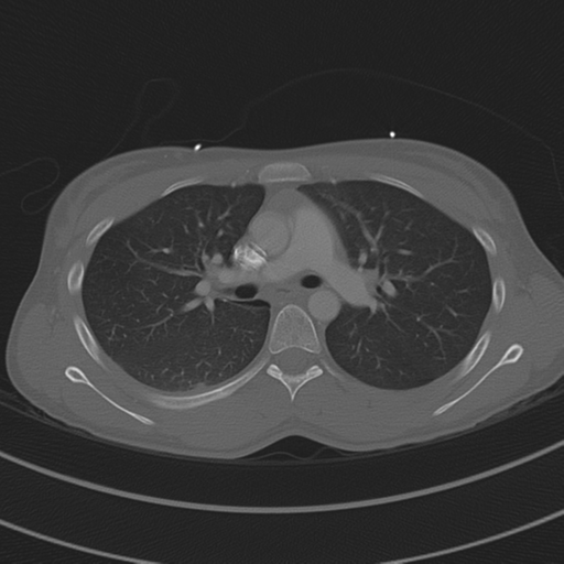 File:Abdominal multi-trauma - devascularised kidney and liver, spleen and pancreatic lacerations (Radiopaedia 34984-36486 I 35).png