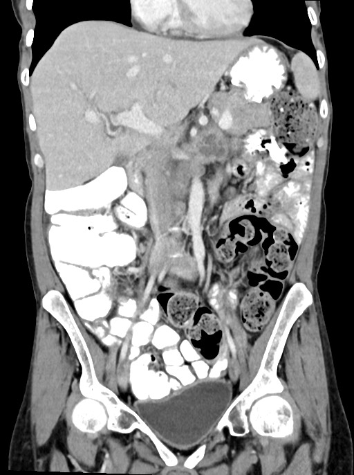 Abdominal wall and retroperitoneal tuberculosis (Radiopaedia 88137-104729 Coronal C+ portal venous phase 45).jpg