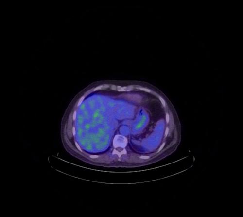 Abdominal wall metastasis from colorectal carcinoma (Radiopaedia 31016-31719 Axial 91).jpg