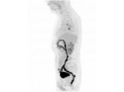 File:Abdominal wall metastasis from colorectal carcinoma (Radiopaedia 31016-31719 Rotational MIP 9).jpg