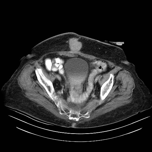 File:Abdominal wall recurrence after colorectal resection for cancer (Radiopaedia 23444-23523 Axial C+ portal venous phase 32).jpg