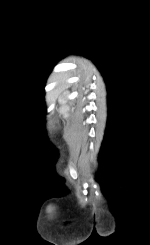 Abdominopelvic rhabdomyosarcoma (Radiopaedia 78356-90984 Coronal C+ portal venous phase 83).jpg