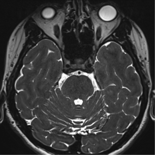 Abducens nerve palsy (Radiopaedia 51069-56648 Axial T2 fat sat 42).png