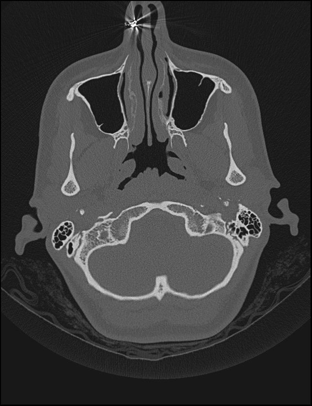 Aberrant right internal carotid artery (Radiopaedia 65191-74198 Axial non-contrast 15).jpg