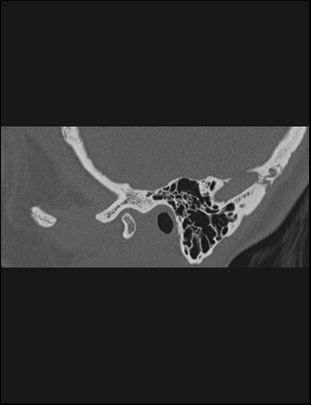 Aberrant right internal carotid artery (Radiopaedia 65191-74198 Sagittal non-contrast 23).jpg