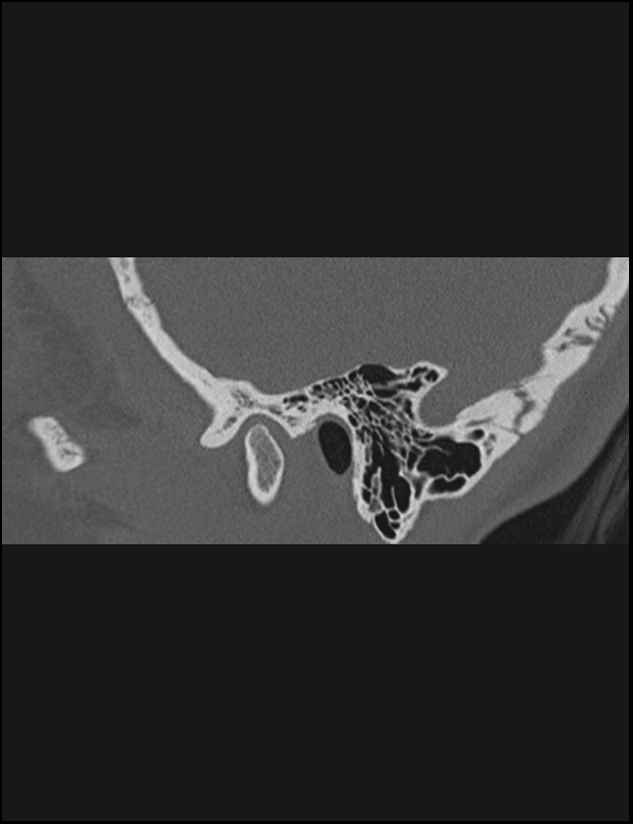 Aberrant right internal carotid artery (Radiopaedia 65191-74198 Sagittal non-contrast 27).jpg