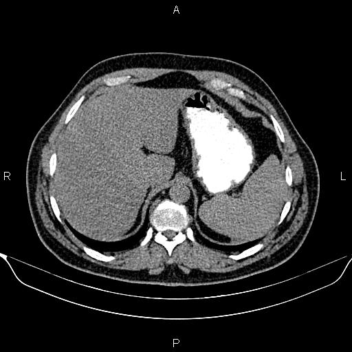 Aberrant right subclavian artery (Radiopaedia 87093-103354 Axial non-contrast 104).jpg