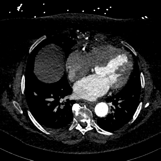 File:Aberrant right subclavian artery with Kommerell diverticulum (Radiopaedia 47982-52769 Axial C+ arterial phase 61).png