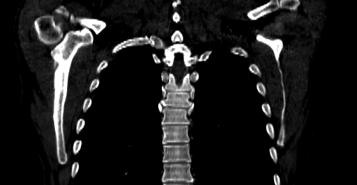 Accesory rib joint (Radiopaedia 71987-82452 Coronal bone window 44).jpg