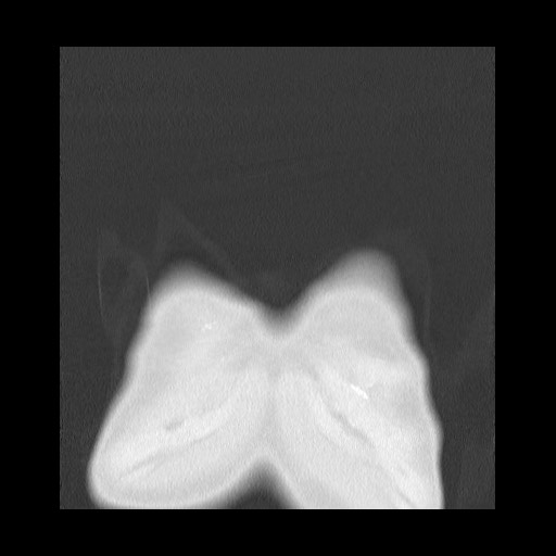 Accessory left horizontal fissure with lingular pneumonia (Radiopaedia 53763-59843 Coronal lung window 3).jpg