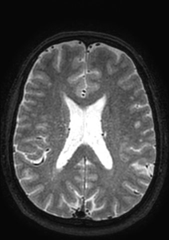 File:Accessory middle cerebral artery (Radiopaedia 73114-83828 Axial T2 31).jpg