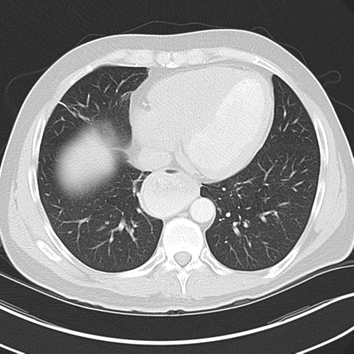 Achalasia of the cardia (Radiopaedia 38497-40595 Axial lung window 37).png