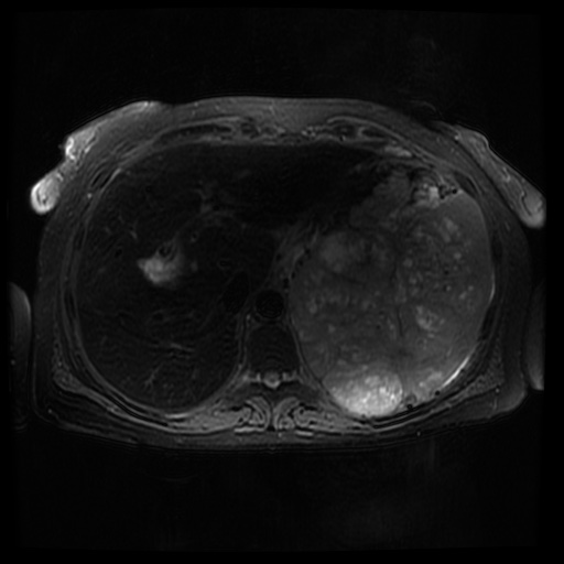 File:Acinar cell carcinoma of the pancreas (Radiopaedia 75442-86668 Axial T2 fat sat 20).jpg