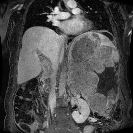Acinar cell carcinoma of the pancreas (Radiopaedia 75442-86668 Coronal T1 C+ fat sat 95).jpg