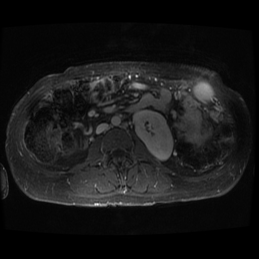 Acinar cell carcinoma of the pancreas (Radiopaedia 75442-86668 D 12).jpg