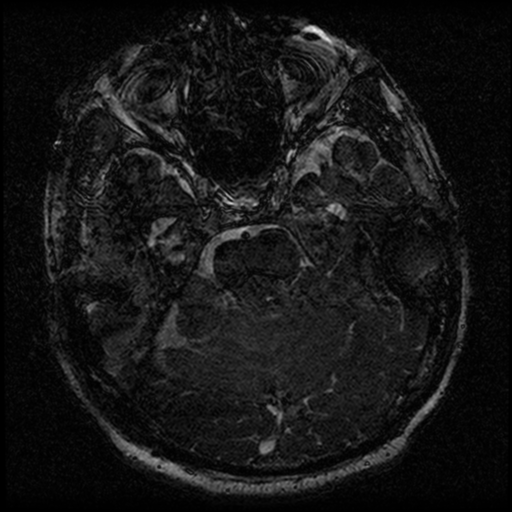 File:Acoustic schwannoma (Radiopaedia 39170-41387 Axial FIESTA 96).png