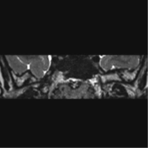 File:Acoustic schwannoma (Radiopaedia 50846-56358 Coronal T2 38).png