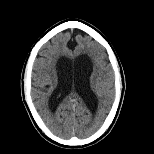 File:Acoustic schwannoma (Radiopaedia 55729-62280 Axial non-contrast 21).png