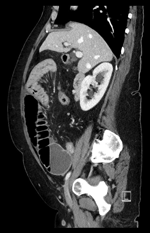 Active Crohn disease (Radiopaedia 59394-66750 Sagittal C+ portal venous phase 38).jpg