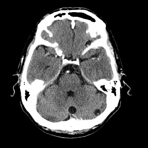 File:Active neurocysticercosis before and after therapy (Radiopaedia 71710-82099 Axial C+ delayed 73).jpg
