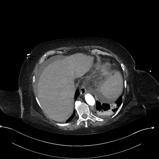 Active renal extravasation with large subcapsular and retroperitoneal hemorrhage (Radiopaedia 60975-68796 Axial C+ arterial phase 32).jpg