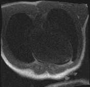 File:Active right ventricular cardiac sarcoidosis (Radiopaedia 55596-62100 Axial Dynamic perfusion scan MOCO 14).jpg