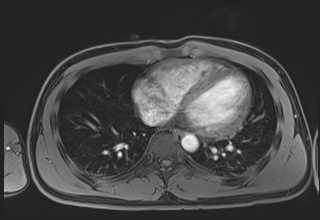 Active right ventricular cardiac sarcoidosis (Radiopaedia 55596-62100 Axial Post contrast Dixon 50).jpg