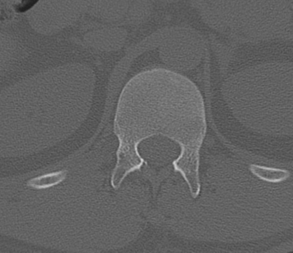 File:Acute L1 burst compression fracture (Radiopaedia 34430-35755 Axial bone window 8).png
