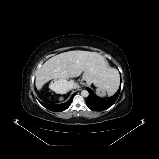 Acute appendicitis, heterotaxy syndrome (Radiopaedia 66884-76202 Axial C+ portal venous phase 27).jpg