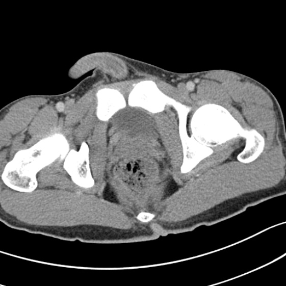 File:Acute appendicitis (Radiopaedia 32614-33572 Axial C+ portal venous phase 67).jpg