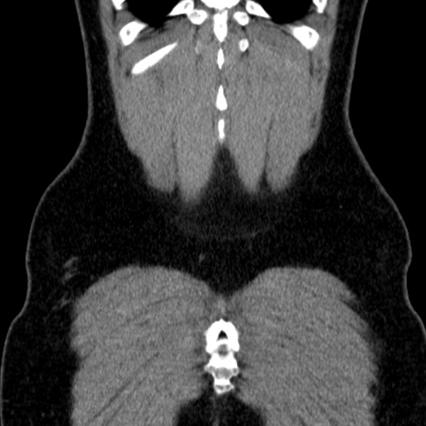 File:Acute appendicitis (Radiopaedia 38255-40270 Coronal C+ portal venous phase 81).jpg