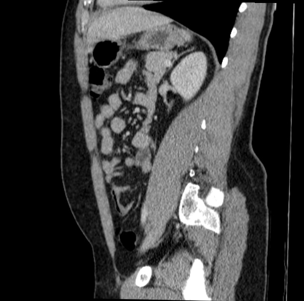 Acute appendicitis (Radiopaedia 38255-40270 Sagittal C+ portal venous phase 54).jpg