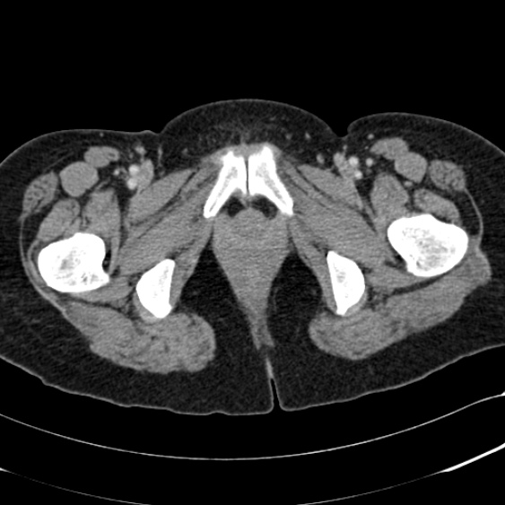 Acute appendicitis (Radiopaedia 48792-53822 Axial C+ portal venous phase 124).jpg