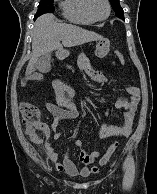 Acute appendicitis (Radiopaedia 58627-65818 Coronal non-contrast 32).jpg