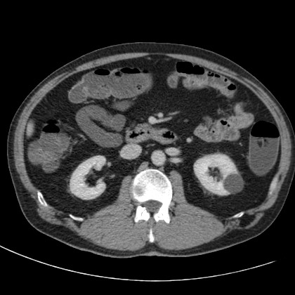 Acute appendicitis (Radiopaedia 66513-75790 Axial C+ portal venous phase 28).jpg
