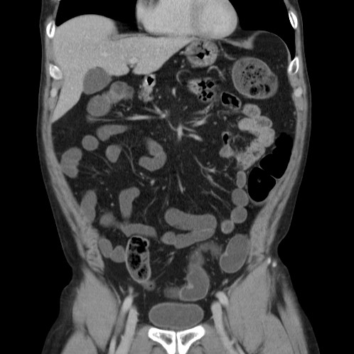 Acute appendicitis (Radiopaedia 66513-75790 Coronal C+ portal venous phase 20).jpg