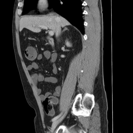 File:Acute appendicitis (Radiopaedia 66513-75790 Sagittal C+ portal venous phase 60).jpg