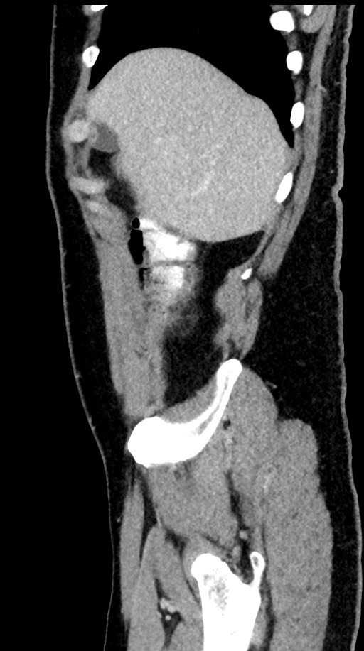 Acute appendicitis (Radiopaedia 77016-88960 Sagittal C+ portal venous phase 97).jpg