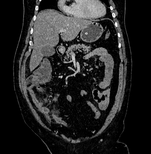 Acute appendicitis (Radiopaedia 79950-93224 Coronal C+ portal venous phase 30).jpg